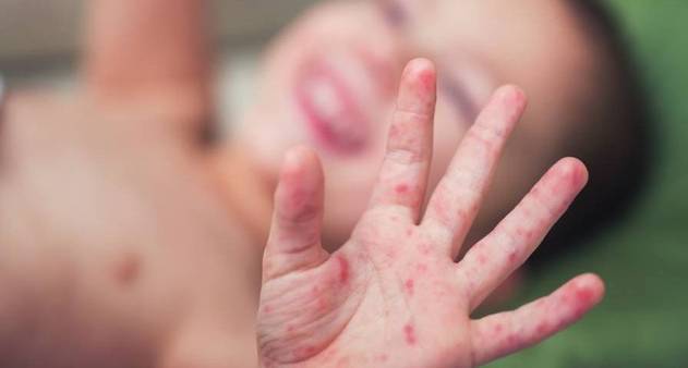 A infecção viral contagiosa foi identificada em 11 crianças da rede municipal